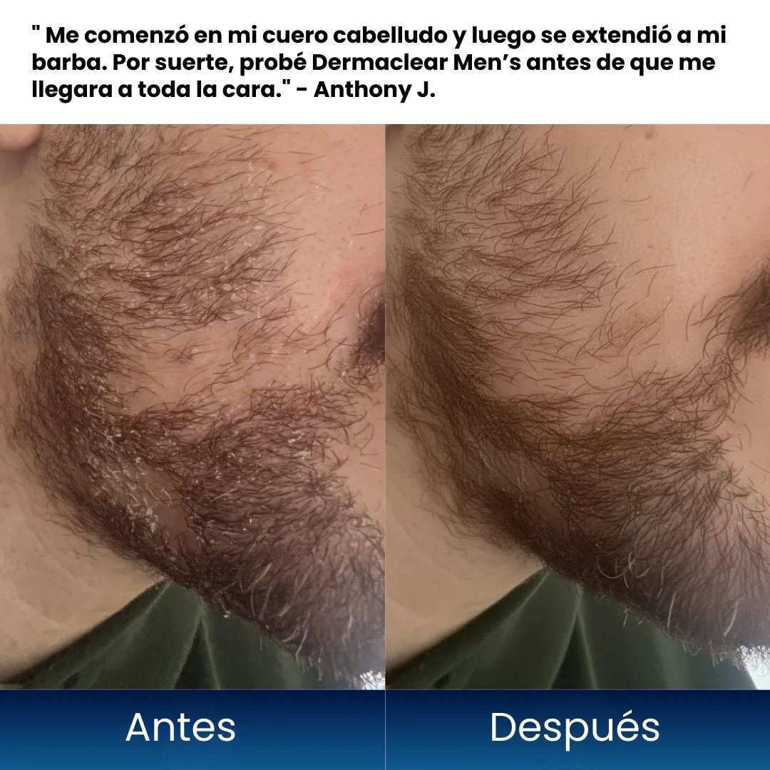 Elimina Escamas e Irritación en el Rostro y cuero cabelludo Masculino - Tratamiento Regenerativo 8 en 1