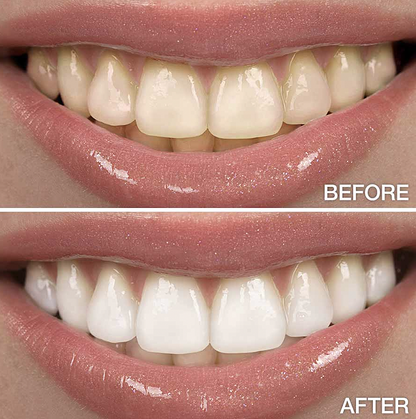 ✨ Next-Gen Dissolving Whitening Strips | Upgraded Formula, Zero Sensitivity 🦷